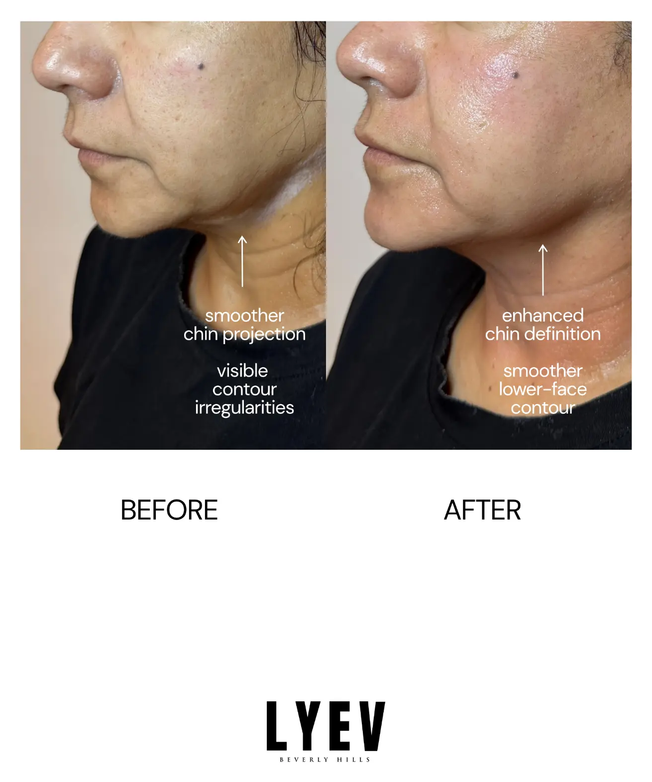 Before and after side profile of a client's lower face filler result, shown side by side