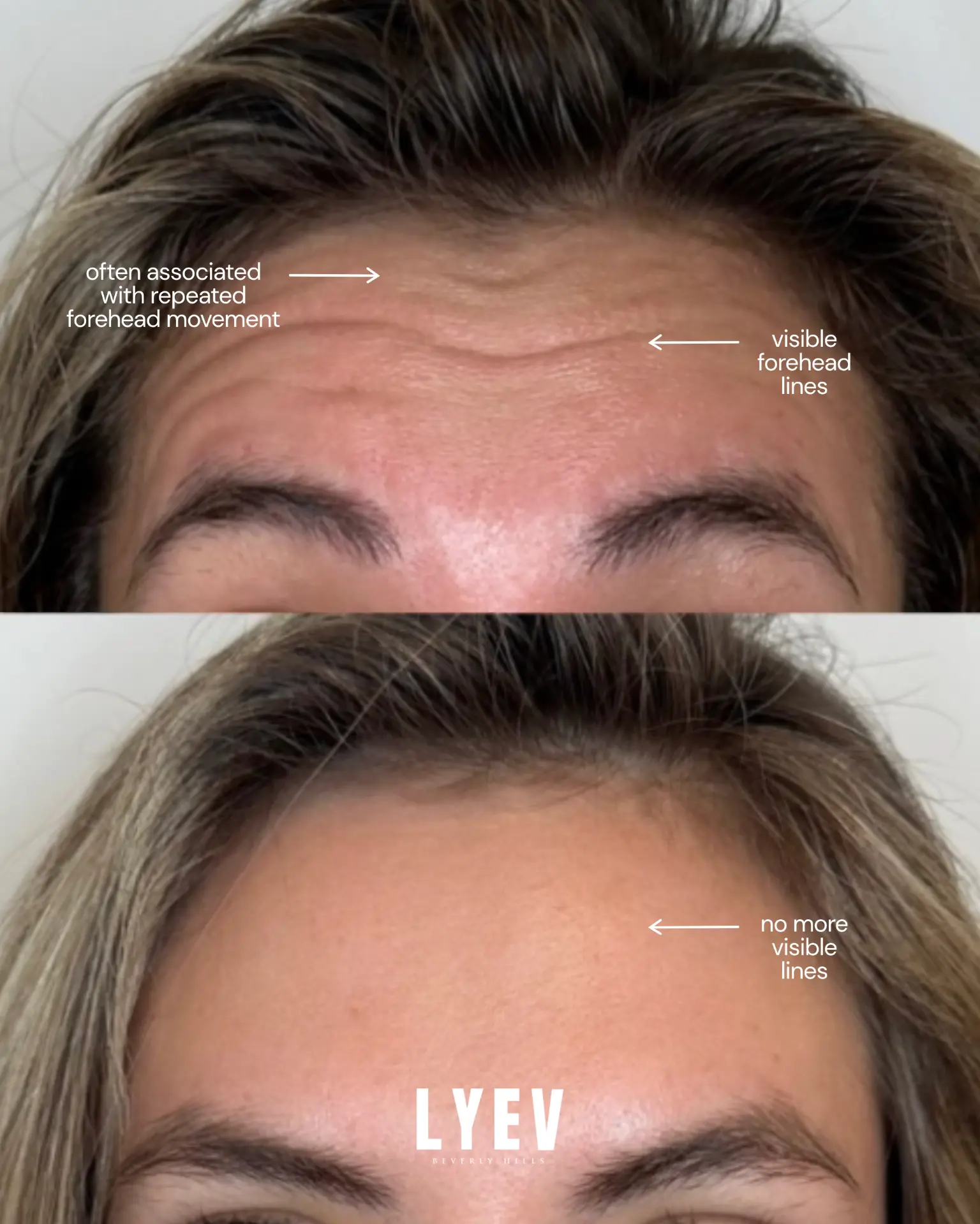 Before (top) and after (bottom) of a client's forehead lines, LYEV tox result