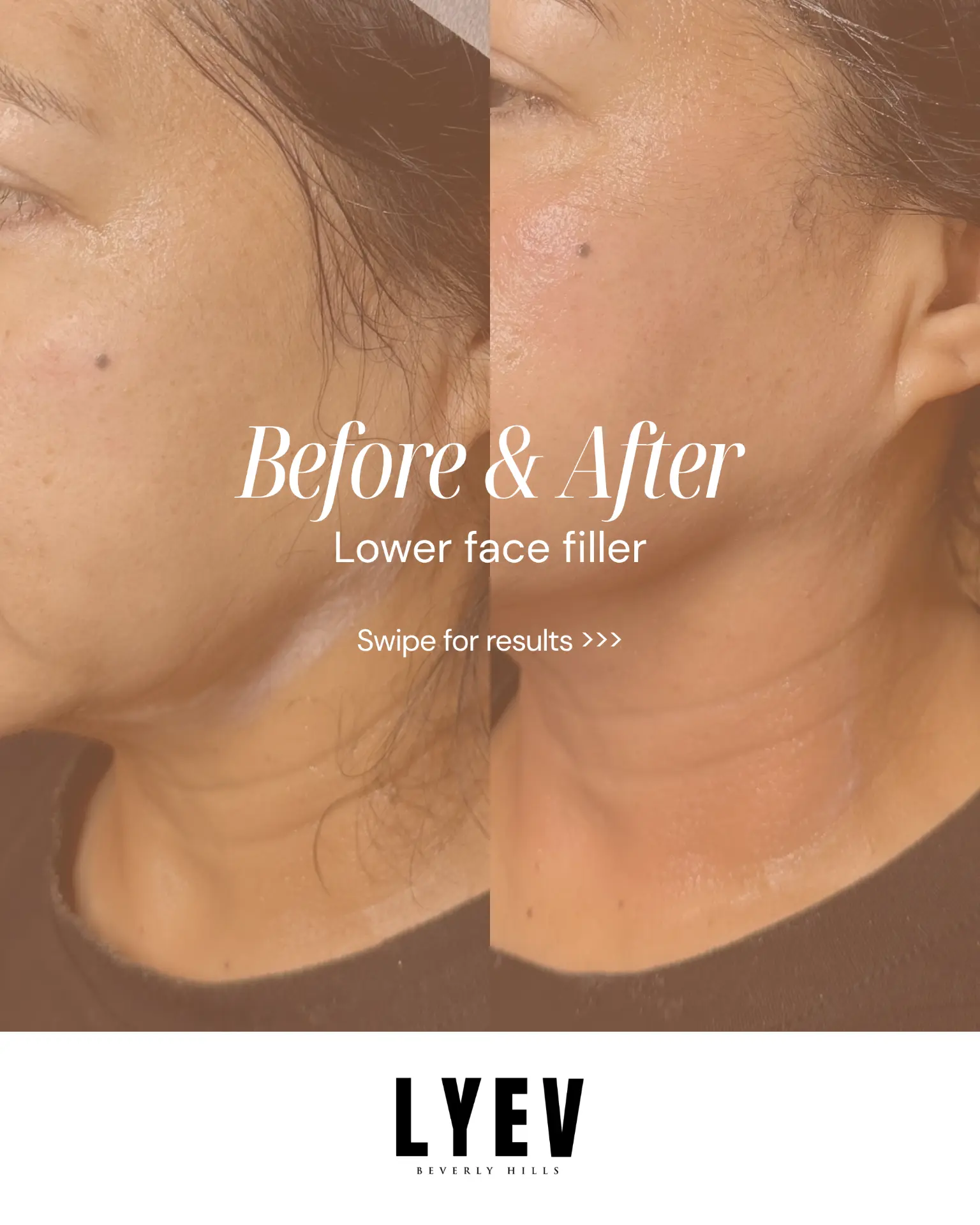 LYEV Before & After cover for a lower face filler result