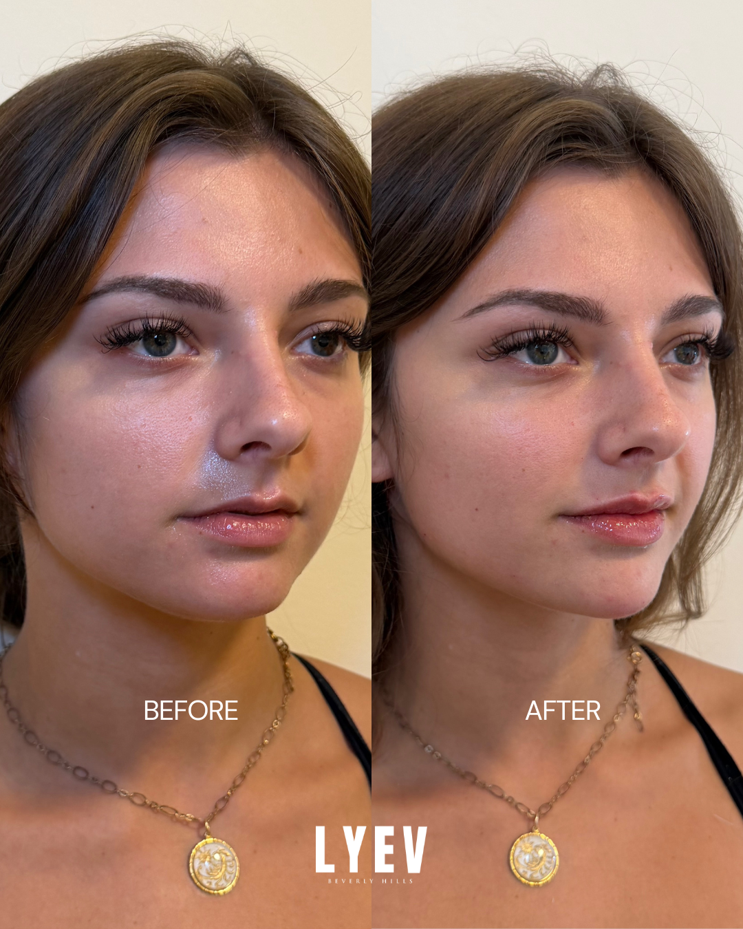 Before and after three-quarter view of a client's chin and lip filler result, shown side by side