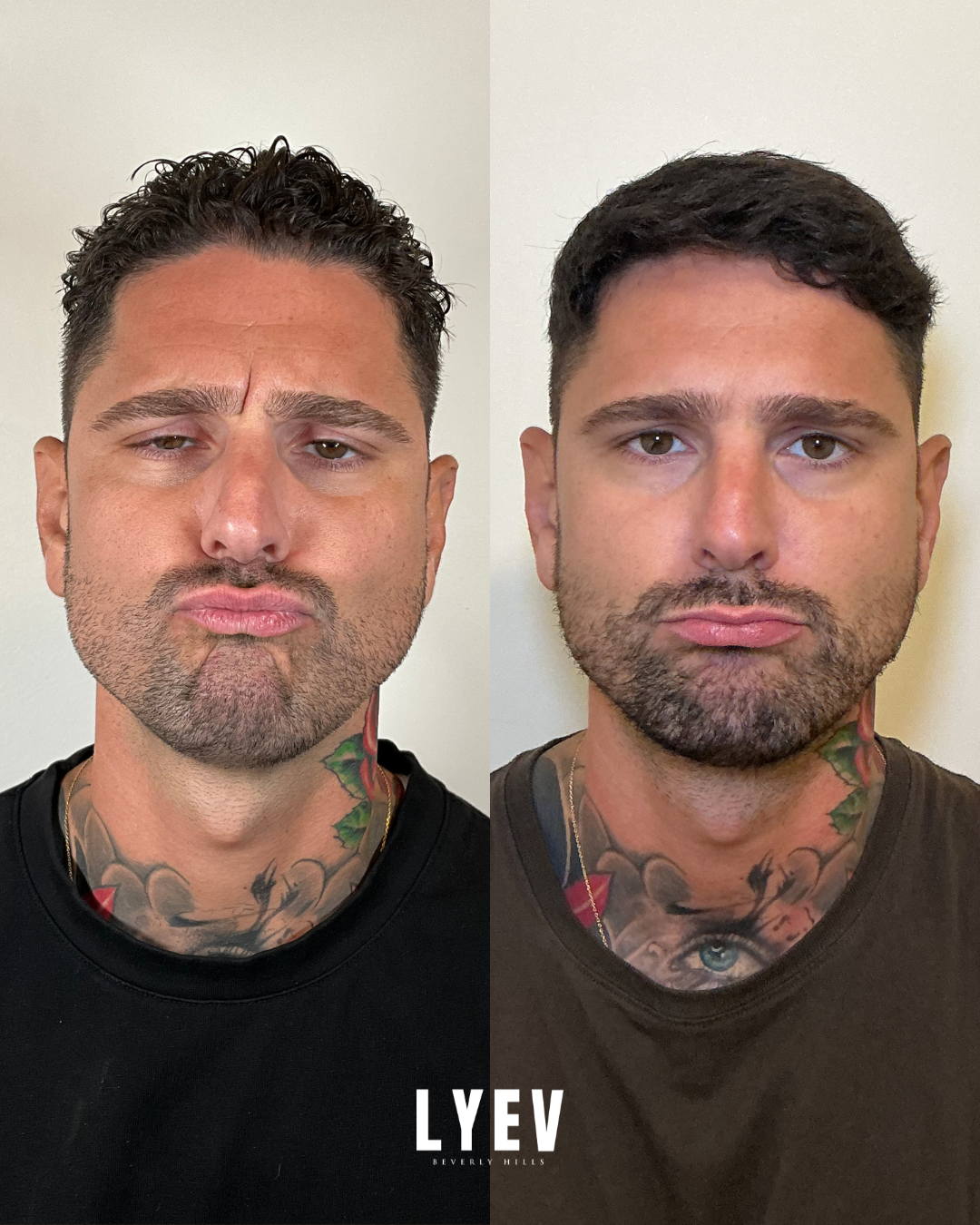 Before and after front view of a male client's Botox result, shown side by side